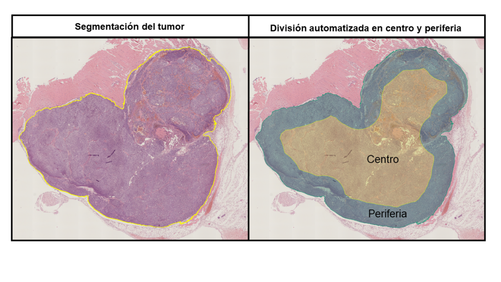 Muestra tumoral neuroblastoma